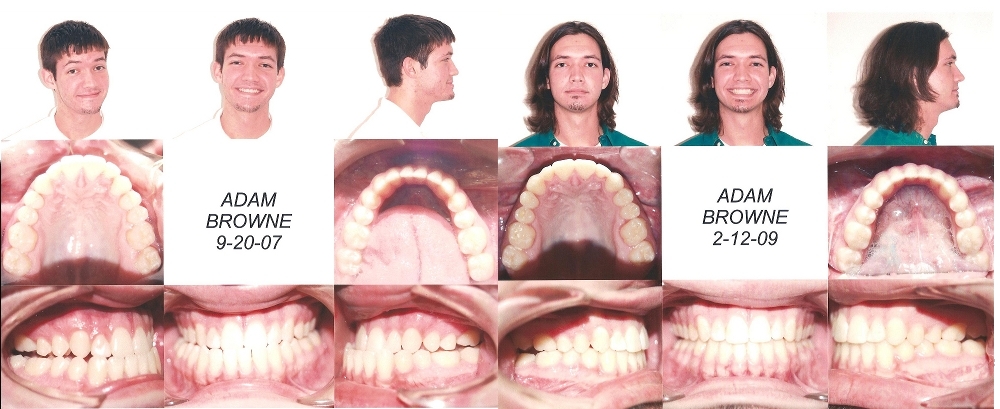 Before and After Jaw Surgery Profile